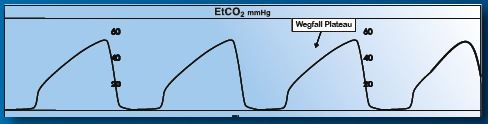 ETCO2